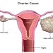 An aspirin a day could slash woman’s ovarian cancer risk -study