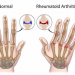 Arthrheuma Society publishes clinical guidelines for Rheumatoid Arthritis