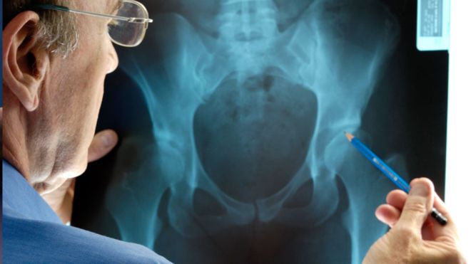 Most hip and knee replacements ‘last longer than thought’