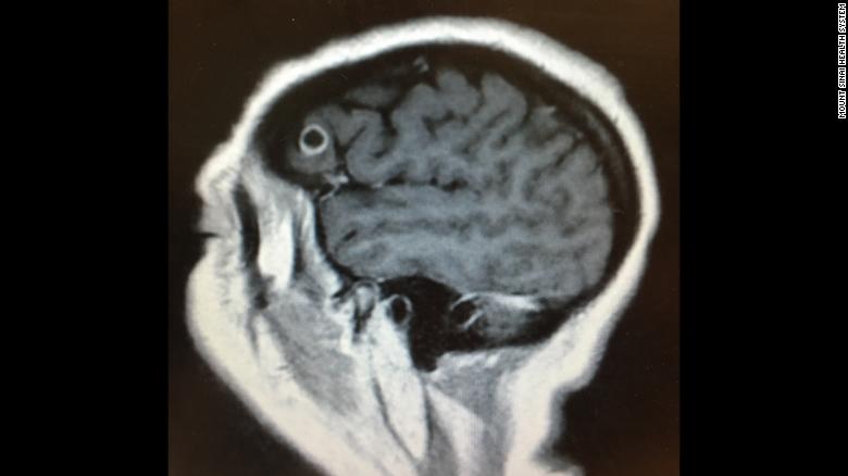 Unusual symptoms pointing to brain cancer turned into something completely different