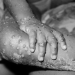 Monkeypox: Cases detected in three more countries for first time