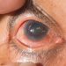 Address gaps in diagnosis and awareness of glaucoma in children to avert Irreversible blindness