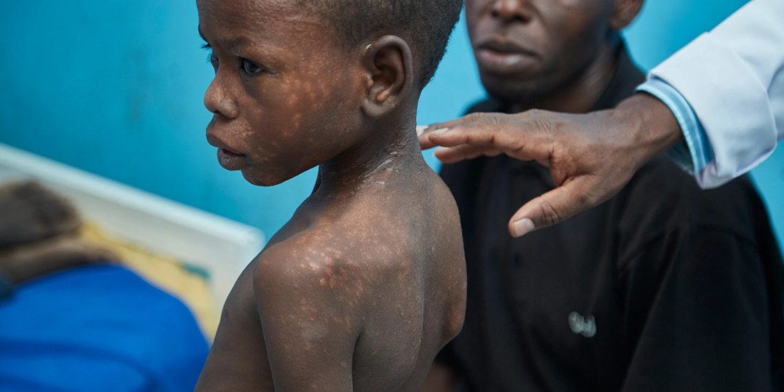 Clinical trial in Eastern Africa finds a shorter, safer, and more effective treatment for PKDL, a stigmatizing skin disease