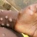 Ministry of Health confirms first MPOX case in Kenya