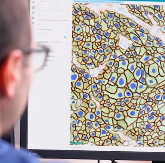 AstraZeneca Reaffirms Commitment to Early Cancer Detection and Holistic Patient Care on World Cancer Day 2025