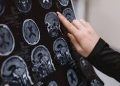 WHO Warns of Rising Neurological Crisis as 11 Million Die Each Year