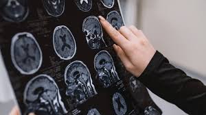 WHO Warns of Rising Neurological Crisis as 11 Million Die Each Year